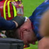 Viktor Gyökeres, accidentare gravă la debutul în Liga Campionilor cu Arsenal! Ce s-a întâmplat?